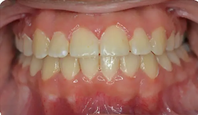 AFter Orthodontic Treatment