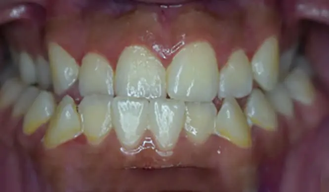 Before Orthodontic Treatment