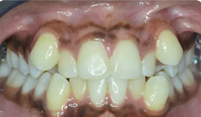 Before Orthodontic Treatment