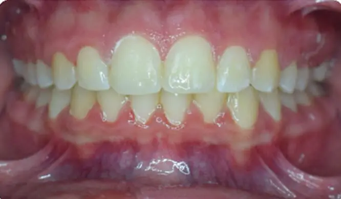 After Orthodontic Treatment