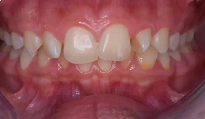 Before Orthodontic Treatment