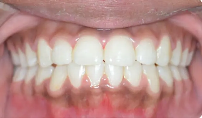 After Orthodontic Treatment