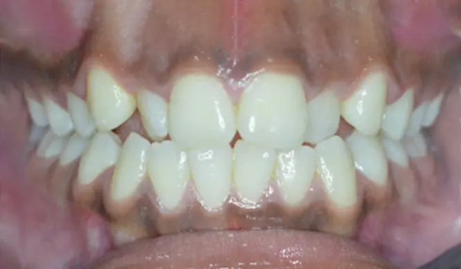 Before Orthodontic Treatment