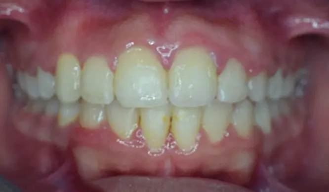 After Orthodontic Treatment