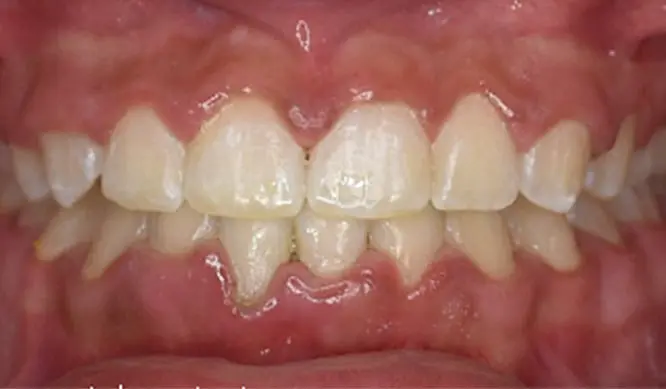 After Orthodontic Treatment