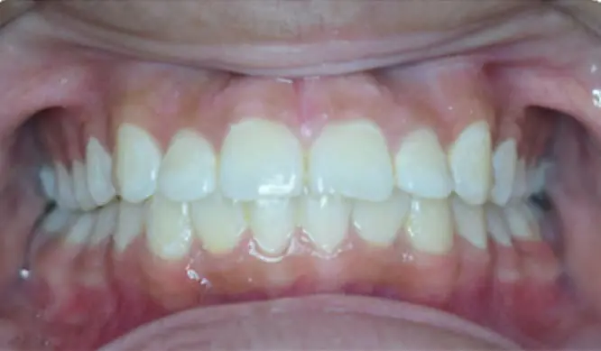 After Orthodontic Treatment