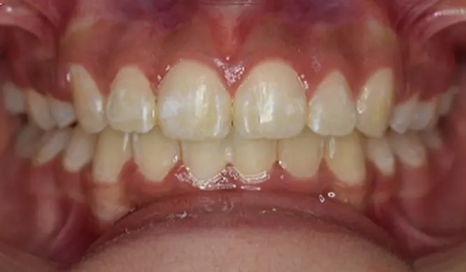After Orthodontic Treatment