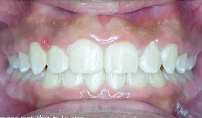 After Orthodontic Treatment