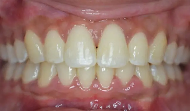 Close-up of a person’s mouth showing straight, aligned teeth with visible gums. Teeth appear healthy and clean, conveying a neutral tone.