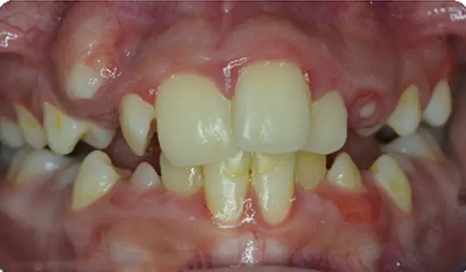 Before Orthodontic Treatment