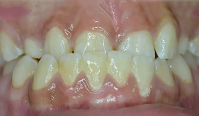 Before Orthodontic Treatment