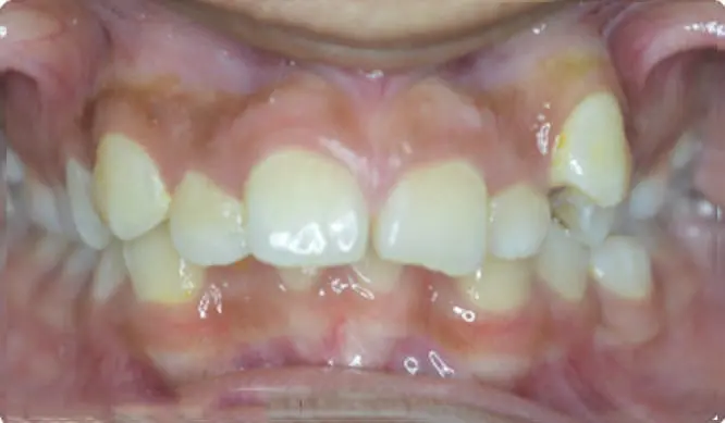 Before Orthodontic Treatment