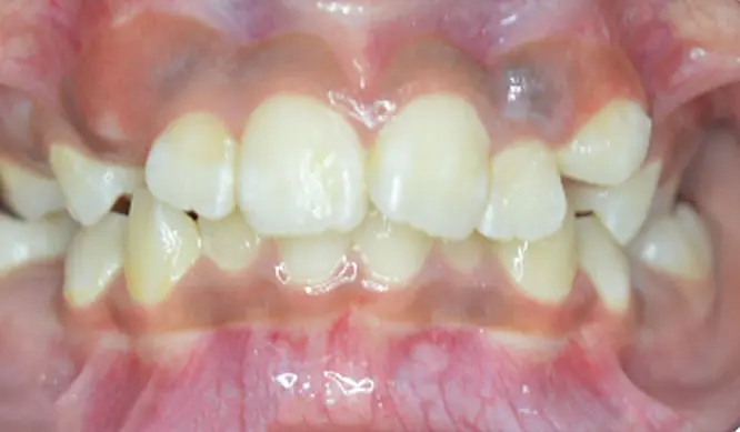 Before Orthodontic Treatment