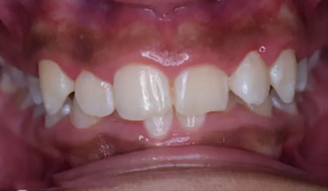 Before Orthodontic Treatment