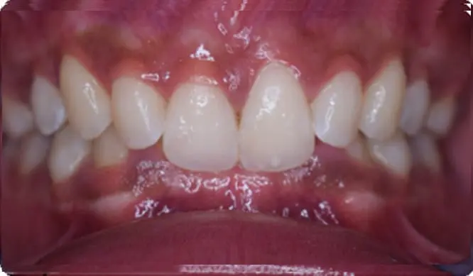 Before Orthodontic Treatment