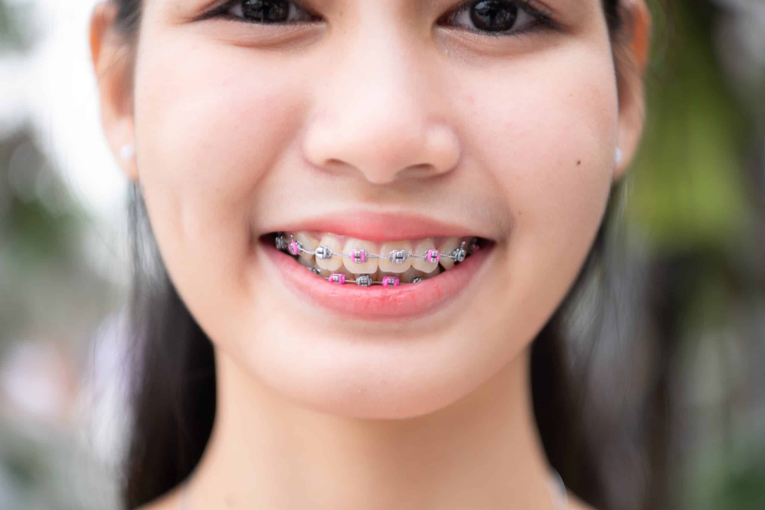 Portrait of a young asian woman with braces on her teeth